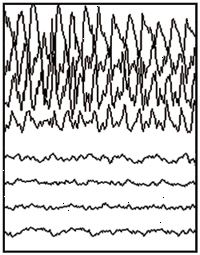 Částečné propadnutí EEG