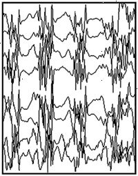 Generalizované záchvaty EEG