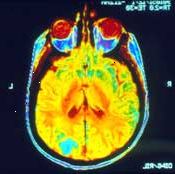 MRI mozku může ukázat, zda rakovina se rozšířila (metastasized) tam.