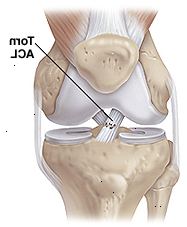 Čelní pohled na kolenního kloubu ukazuje svaly, kosti a vazy s částečným trhlinou předního zkříženého vazu.