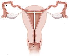 Průřez dělohy a pochvy představení IUD v místě uvnitř dělohy.