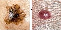 Foto porovnání normální a melanomu molů zobrazující asymetrie