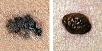 Foto porovnání normální a melanomu krtky zobrazující hranice nesrovnalost