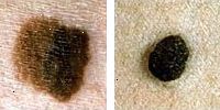 Foto porovnání normální a melanomu molů ukazuje barvu