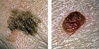 Foto porovnání normální a melanomu molů ukazující průměr