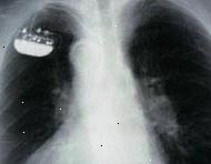 X-ray jednokomorový implantován kardiostimulátor