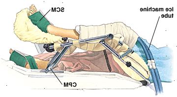 Osoba ležící na nemocničním lůžku s podporovanou kontinuální pasivní pohyb stroje jednom koleni. Koleno je zabalen a led stroje trubky jít za balení. Sekvenční kompresní manžety jsou omotané kolem obou nohou.