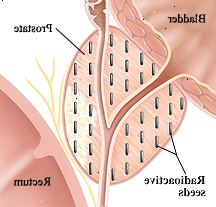Detailní průřez močového měchýře, prostaty, a konečníku. Radioaktivní semena jsou implantovány v celé prostaty.