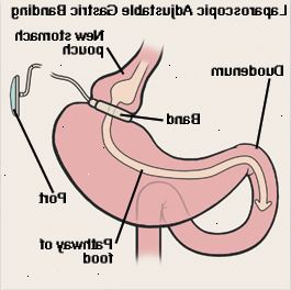 Čelní pohled na žaludku a dvanáctníku ukazuje laparoskopické nastavitelná bandáž žaludku. Kapela se pohybuje kolem horní části žaludku, vytváří malý váček. Kapela je spojen trubkou do přístavu těsně pod kůží. Šipka ukazuje cestu potravy přes žaludku váček, žaludku a dvanáctníku.