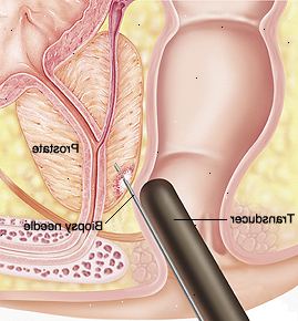 Detailní průřez prostaty a konečníku. Převodník je vložen do konečníku a jehla je vložena do prostaty.
