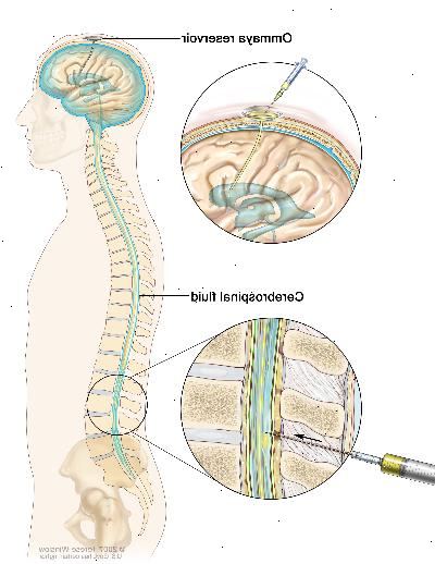 Intratekální chemoterapie. Protinádorové léky se vstřikuje do intratekálního prostoru, což je prostor, který má do mozkomíšního moku (CSF, zobrazí modře). Existují dva různé způsoby, jak toho dosáhnout. Jedním ze způsobů, je znázorněno v horní části obrázku, je injekčně drogy do zásobníku Ommaya (kontejner ve tvaru kopule, která je umístěna pod hlavě v průběhu chirurgického zákroku, je to má léky, když proudí přes malou trubku do mozku ). Druhým způsobem, je znázorněno ve spodní části obrázku, je aplikovat léky přímo do CSF ​​v dolní části páteře, po malé ploše na dolní části zad je zkřehlé.