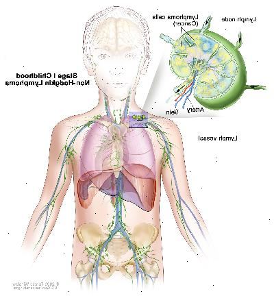 Etapa I dětství non-Hodgkinova lymfomu, rakoviny výkres ukazuje v jedné skupině lymfatických uzlin. Vložka ukazuje lymfatické uzliny s lymfatickou plavidla, tepny a žíly. Lymfomové buňky obsahující rakovinu, jsou uvedeny v lymfatické uzlině.