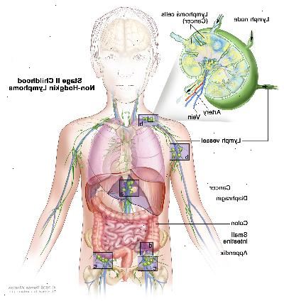 Stage II dětství non-Hodgkinova lymfomu, výkres ukazuje rakovinu lymfatických uzlin skupinách nad a pod membránou, v játrech a v příloze. Tlustého střeva a tenkého střeva, jsou také uvedeny. Vložka ukazuje lymfatické uzliny s lymfatickou plavidla, tepny a žíly. Lymfomové buňky obsahující rakovinu, jsou uvedeny v lymfatické uzlině.