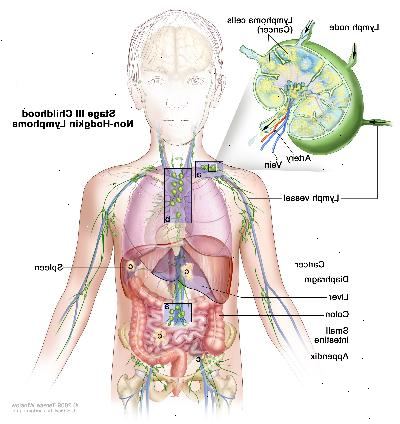Etapa III dětství non-Hodgkinova lymfomu, výkres ukazuje rakovinu lymfatických uzlin skupinách nad a pod membránou, na hrudi a na celém břiše v játrech, slezině, tenkém střevě, a přílohy. Tlustého střeva je rovněž uvedena. Vložka ukazuje lymfatické uzliny s lymfatickou plavidla, tepny a žíly. Lymfomové buňky obsahující rakovinu, jsou uvedeny v lymfatické uzlině.