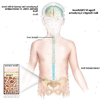 Etapa IV dětství non-Hodgkinova lymfomu, kresba zobrazuje mozek, míchu, a mozkomíšního moku a kolem mozku a míchy. Vsazení ukazuje rakovinu v kostní dřeni.