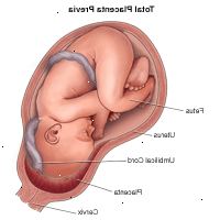 Ilustrace demonstrovat celkový placenta previa