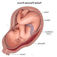 Ilustrace prokázání částečné placenta previa