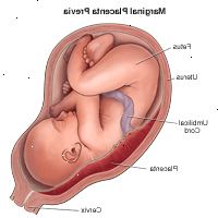Ilustrace marginální placenta previa