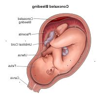 Ilustrace prokazující skryté krvácení během těhotenství