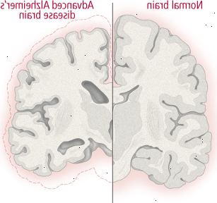 Změny mozku u Alzheimerovy nemoci