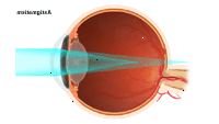 Ilustrace prokazující astigmatismus