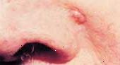 Bazální karcinomy tvoří na místech vystavených slunci a vypadají zvedl a perleťově.