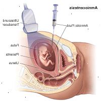 Ilustrace prokázání o amniocentézu