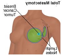 Ilustrace z celkového mastektomii