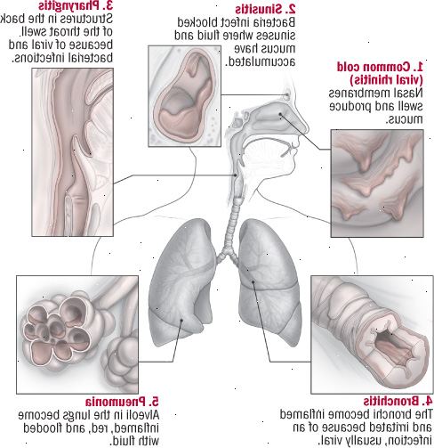 Pět infekce dýchacích cest
