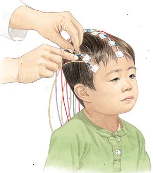 Při EEG elektrody jsou umístěny na pokožce hlavy vašeho dítěte, takže elektrická aktivita mozku může být zaznamenán.