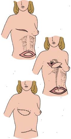 Postup Tramvaj klapka ukazuje, jak se břišní tkáň slouží k rekonstrukci odstranit prsa