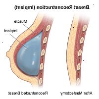 Ilustrace bočního pohledu prsu, před a po rekonstrukci (implantát)