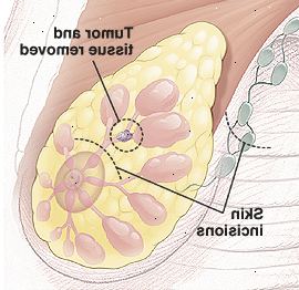 Prsa anatomie s kruhem kolem nádoru v potrubí ukazuje tkáně, které mají být odstraněny. K dispozici jsou tečkované čáry nad bradavku a v podpaží, které ukazují malé zakřivené řezné stránky.