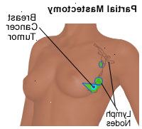 Ilustrace částečné mastektomii