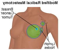 Ilustrace modifikované radikální mastektomii