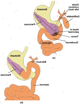 Pyloru-zachování pancreaticoduodenectomy: anatomie resekované oblasti (a) a znovu trávicího traktu s end-to-end pancreaticojejunostomy (b).