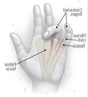 Anatomie kontraktury Dupuytrenovou
