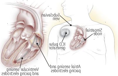 Implantabilních defibrilátorů