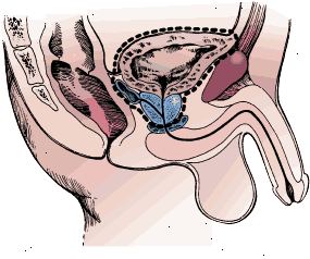 Chirurgické hranice radikální cystektomii v člověku. Vzorek obsahuje močového měchýře, prostaty a semenných váčků.