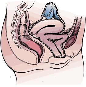Chirurgické hranice radikální cystektomie u ženy. Vzorek obsahuje močový měchýř a močovou trubici celé, děloha, vaječníky, vejcovody, a přední stěny pochvy.