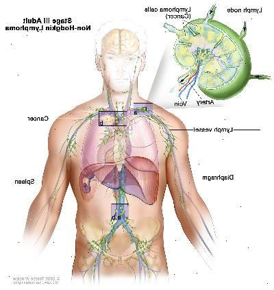 Etapa III dospělý non-Hodgkinův lymfom. Rakovina se nachází v jedné nebo více skupin lymfatických uzlin nad a pod membránou (a). V kroku IIIE, rakovina se vyskytuje v lymfatických uzlin skupinách nad a pod membránou a mimo lymfatických uzlin v blízkém orgánu nebo prostoru (B). V prvním stupni IIIS, rakovina se vyskytuje v lymfatických uzlin skupinách nad a pod membránou (a) a ve slezině (c). Ve fázi IIIS navíc E, rakovina se vyskytuje v lymfatických uzlin skupinách nad a pod membránou, mimo lymfatických uzlin v blízkém orgánu nebo prostoru (B), a ve slezině (c).