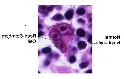 Reed-Sternberg buňky. Reed-Sternberg buňky jsou velké, abnormální lymfocyty, které mohou obsahovat více než jedno jádro. Tyto buňky se nacházejí v Hodgkin lymfom.