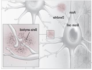 Beta-amyloid plakety